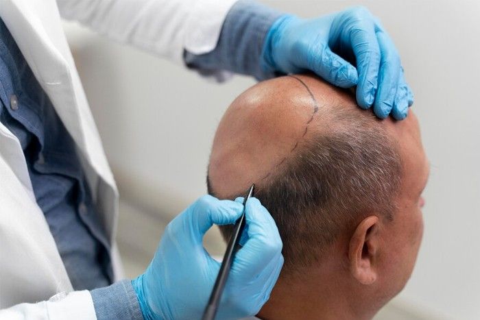 Why Choose Resplendent Cosmetics for Hair Transplant in Delhi